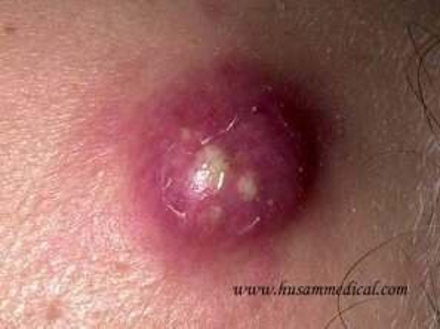 <p>localized collection of pus at the site of an infection (staphylococcal infection)</p>