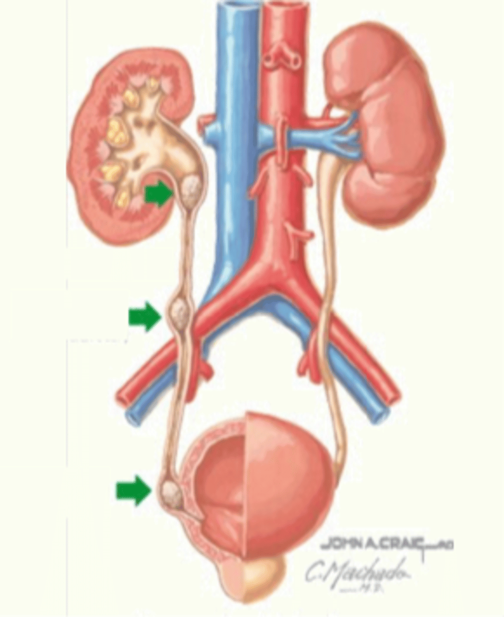 <p>• occur more frequently in men than women, ages between 20-60, usually due to sedentary lifestyles</p><p>• stones = polycrystalline aggregates of calcium, phosphate, oxalate, rate, and other soluble salts within an organic matrix </p><p>• blood in the urine (hematuria) may be also noted </p>