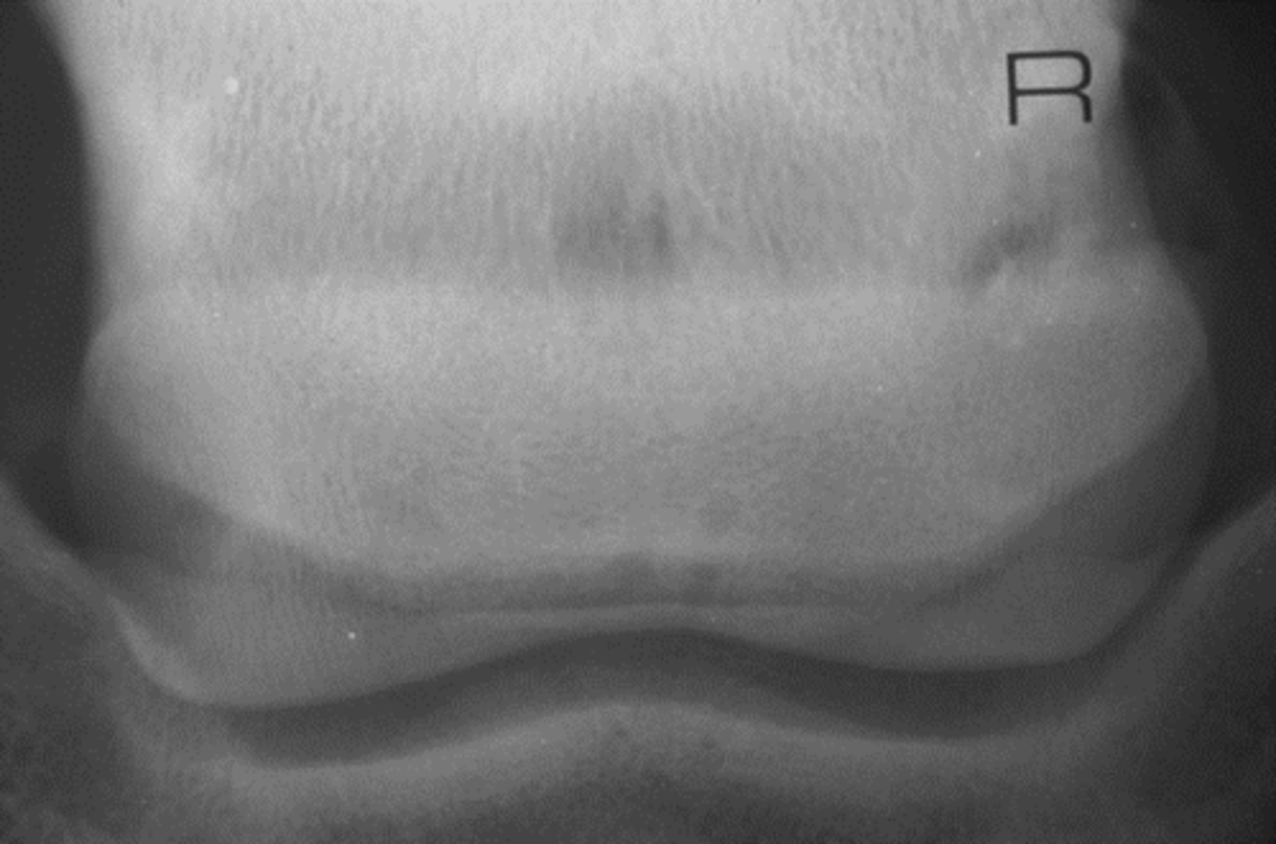 <p>What is highlighted in a 65* DP view in a navicular series?</p>