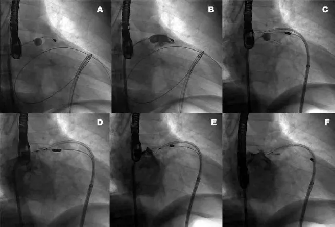 <p>what device is being deployed in this fluoroscopy </p><ol><li><p>device </p></li><li><p>access</p></li><li><p>function</p></li></ol><p></p>