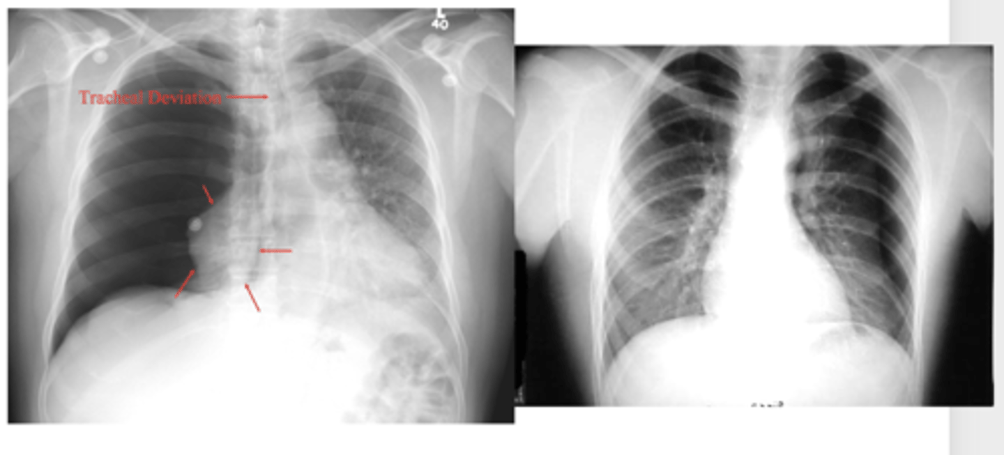 <p>Difference between tension and moderate pneumothorax</p>