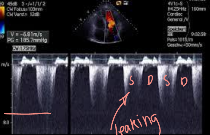 <p>LA pressure (LAP) = systolic BP - MR gradient</p>
