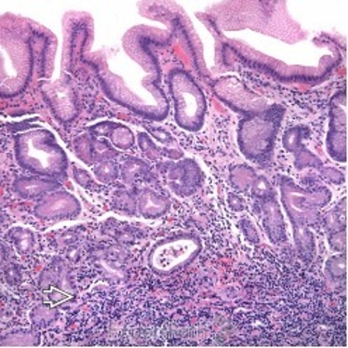<p>Define Condition:</p><p>Autoimmune destruction of gastric parietal cells &amp; Chief Cells (fundus &amp; body)</p><p>-Hx:</p><p>&gt; MC in WOMEN</p><p>&gt; A/w HLA-DR Antigens</p><p>-Path: </p><p>&gt; AutoAbs (T-Cell mediated) destruction to parietal cells &amp; IF</p><p>&gt; Destroyed parietal cells (Fundus/Body - Spares Antrum) --&gt; Less acid secretion --&gt; MORE GASTRIN SECRETION ==&gt; Neuroendocrine Hyperplasia &amp; Possible Carcinoid Tumors</p><p>&gt; Destroyed Chief Cells --&gt; Less Pepsinogen</p><p>-Dx:</p><p>&gt; Biopsy: (LOOKS LIKE ANTRUM - No Oxyntic Mucosa)</p><p>&gt;&gt; Lymphocytes &amp; Plasma Cells</p><p>&gt;&gt; Enterochromaffin-like Cell Hyperplasia ==&gt; Carcinoid Tumor</p><p>&gt;&gt; Atrophic-appearing mucosa</p><p>&gt;&gt; Intestinal Metaplasia</p><p>-Tx:</p><p>-Prog:</p><p>&gt; Pernicious Anemia (Vit B12 deficiency)</p><p>&gt; Increased risk of Gastric Adenocarcinoma</p>