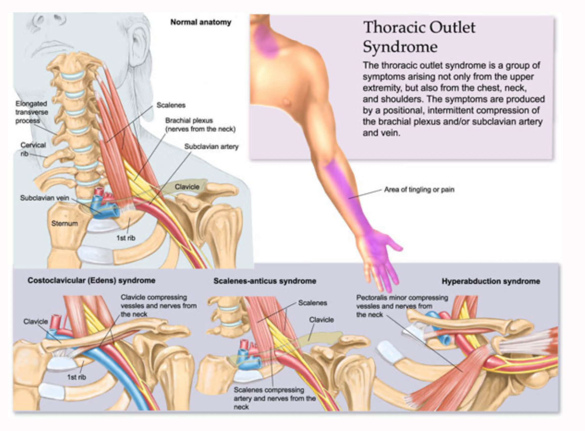 <p>What is thoracic outlet syndrome?</p>