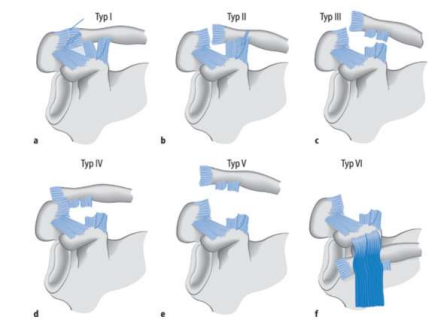 <p>Schultereckgelenksprengung</p><p>Einteilung nach <strong>Rockwood </strong>(1-6)</p><ul><li><p>1-3 konservativ</p></li><li><p>4-6 operativ</p></li></ul><p></p>