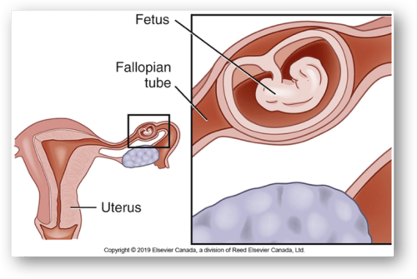 <p>Ectopic pregnancy in fallopian tube</p>