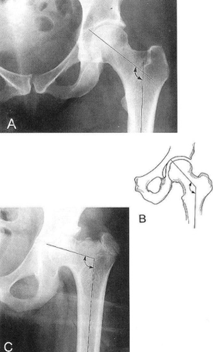 <p>What views are used to measure the femoral angle?</p>