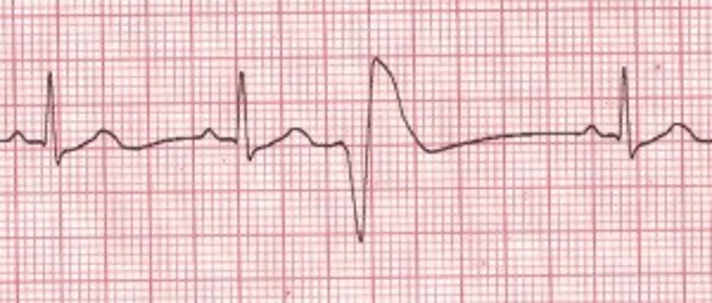 <p>PVC (Premature ventricular contractions)</p>