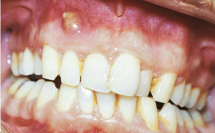 <p><span><span>The contents of the pustule apical to #7 is most likely what substance?</span></span></p>