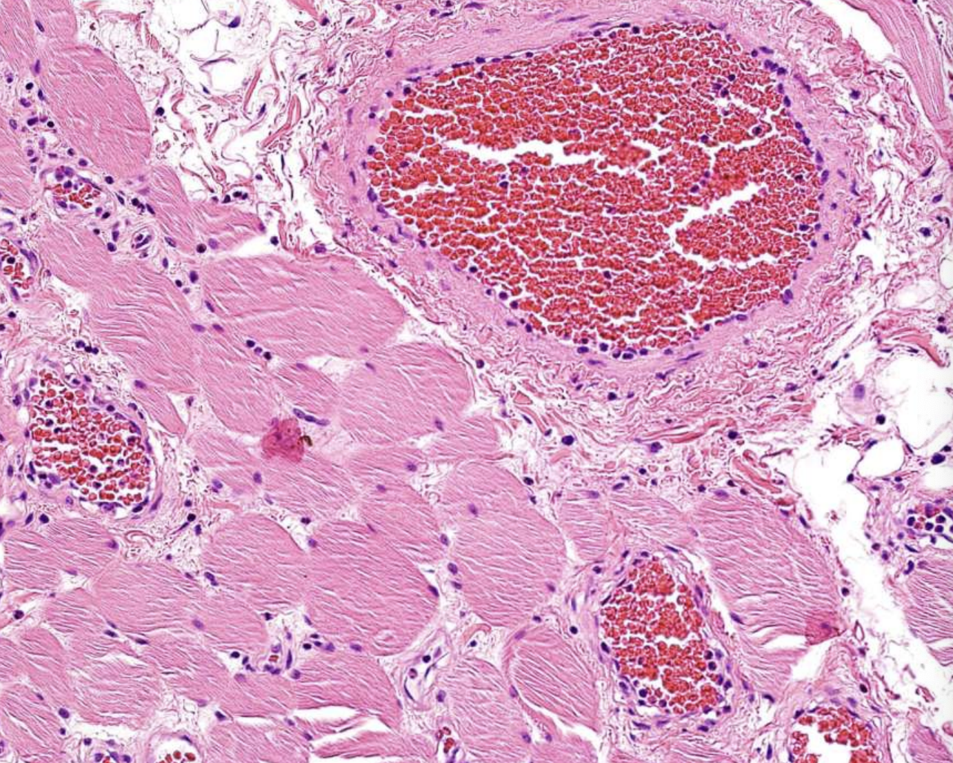 <p>Proliferation of capillaries and endothelial cells containing abundant blood</p>