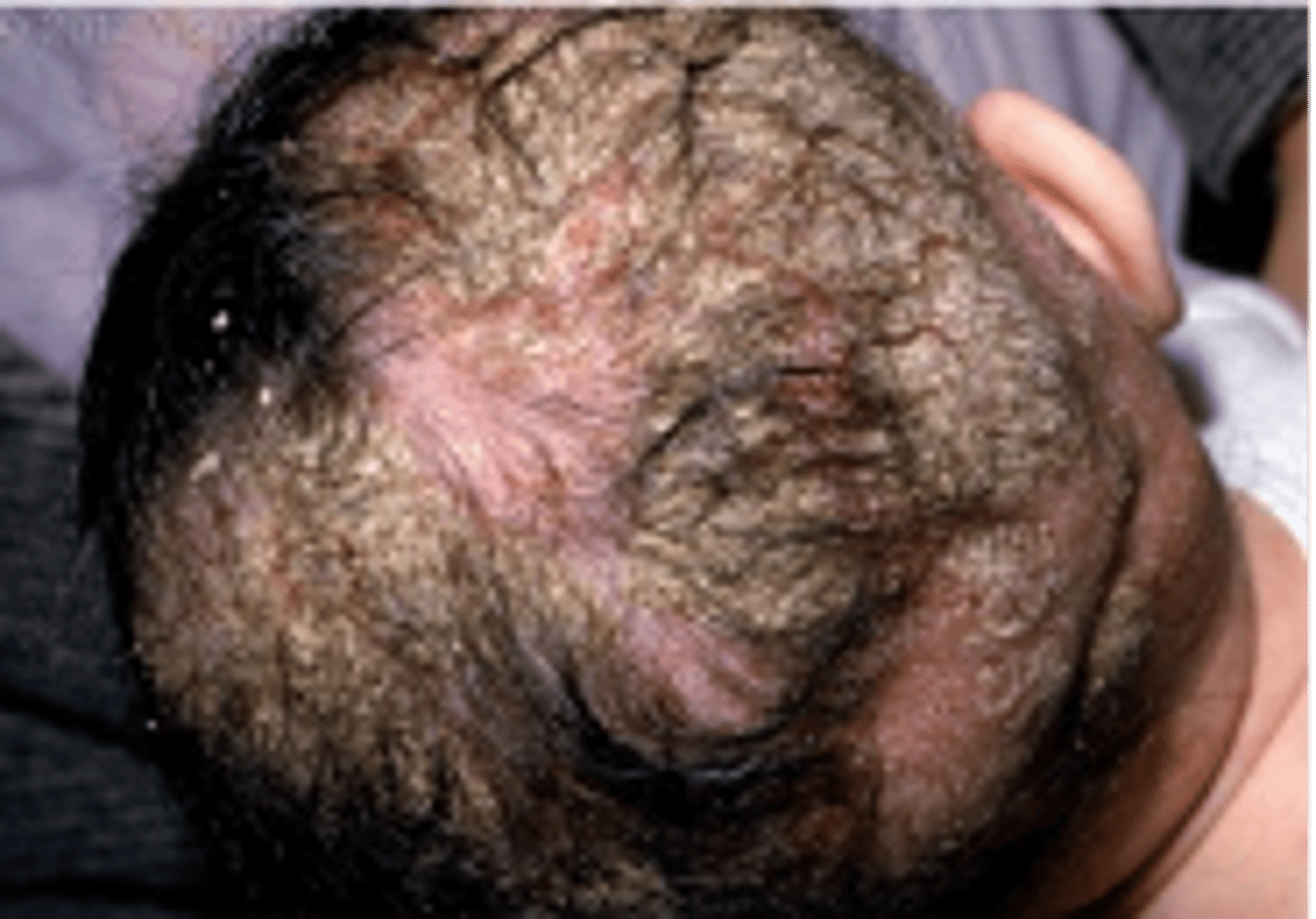 <p>crusting white/yellow oily scales on a baby's scalp or forehead, clears spontaneously in the first 6-12 months</p>