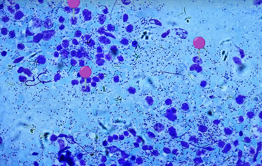 <p><span data-name="large_blue_diamond" data-type="emoji">🔷</span><span data-name="cockroach" data-type="emoji">🪳</span><span><span> </span></span><strong><em>Leishmania donovani </em></strong><sub>(Amastigota)</sub></p><p></p><p></p><p><span>🧩🦠 </span><strong>Organelle:</strong></p><p></p><ul><li><p><span>🟣 - jądro komórkowe; wici są zredukowane i niewidoczne.</span></p></li></ul><p></p><p></p><p><span>😷❓ </span><strong>Parazytoza:</strong><em> Leiszmanioza</em></p>