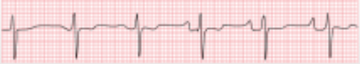 <p>Determine the atrial dysrhythmia:</p><p>Different presentation of P waves every PQRST</p>