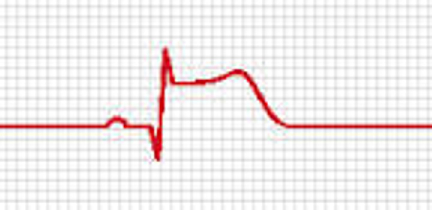 <p>Which Arrythmia is this?</p>