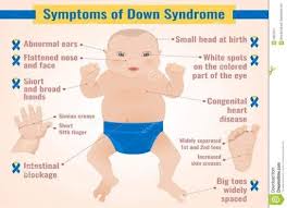 <p>Trisomy 21 - Down Syndrome</p><ul><li><p>an individual has 47 chromosomes, not 46</p></li><li><p>has 3 copies of chromosome 21 instead of the normal 2</p></li><li><p><span><span>symptoms/side effects: intellectual disability, developmental delays, and distinct physical traits like a flat facial profile, small ears/mouth, almond-shaped eyes, or poor muscle tone</span></span></p></li></ul><p></p>
