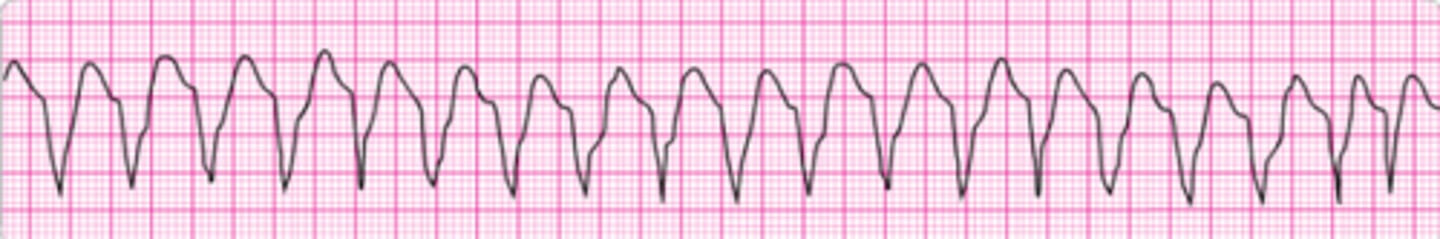 <p>You are monitoring a patient. He suddenly has the persistent rhythm shown below. You ask about symptoms and he reports that he has mild palpitations, but otherwise he is clinically stable with unchanged vital signs. What is your next action?</p><p>1. Give an immediate synchronized shock.</p><p>2. Give sedation and perform synchronized cardioversion.</p><p>3. Administer magnesium sulfate 1 to 2 g IV diluted in 10 mL D5W given over 5 to 20 minutes.</p><p>4. Give an immediate unsynchronized shock.</p><p>5. Administer adenosine 6 mg; seek expert consultation.</p>