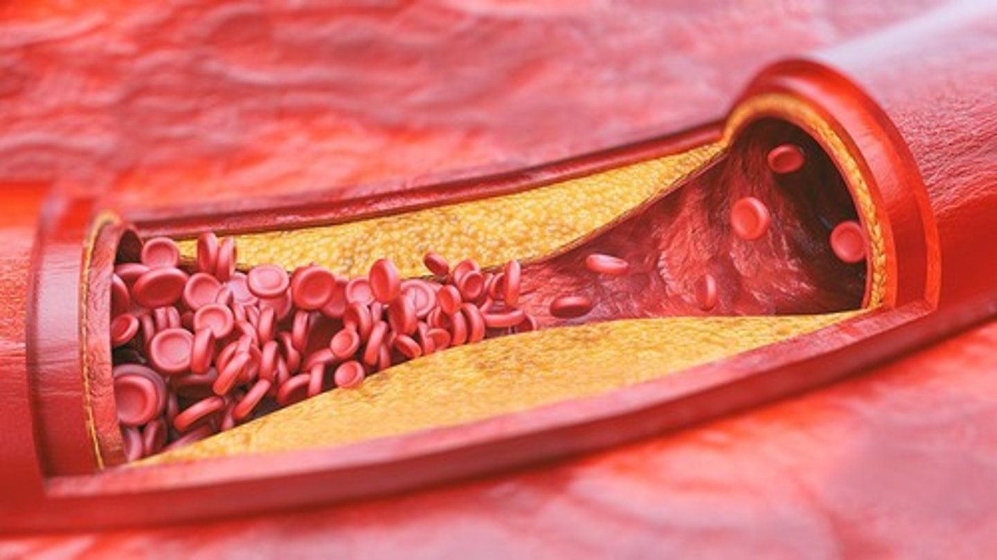 <p>Hardening of arteries due to plaque causing decreased blood flow</p><p>Clot = Atheroma</p><p>Predominantly in the legs - intermittent claudication</p>