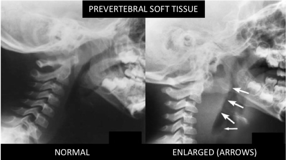 <p>follows suppurative URI, posterior pharynx swelling, sore throat, fever, neck stiffness, stridor, drooling</p>