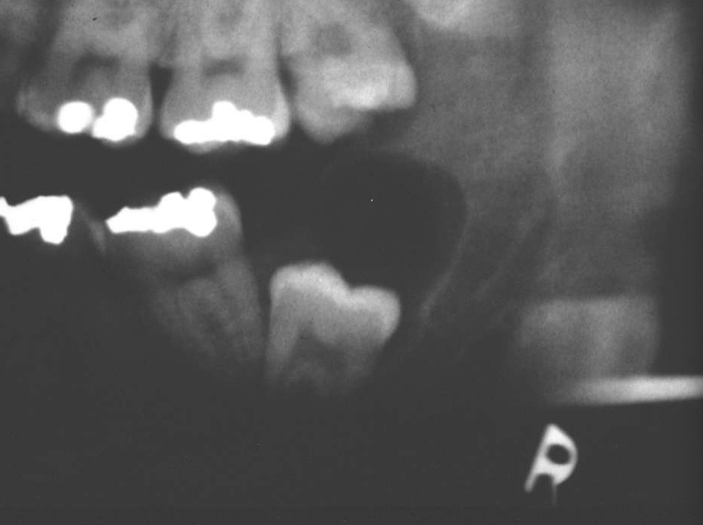 <p>dentigerous cysts</p>