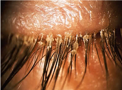 <ul><li><p>less common, <strong><u>very itchy</u></strong></p></li></ul><p></p><p>demodex:</p><ul><li><p><strong>cylindrical deposits</strong> extending up lashes</p></li></ul><p></p><ul><li><p><strong>lash misdirection/loss</strong> , general redness</p></li></ul><p></p><ul><li><p>itching</p></li></ul><p></p>