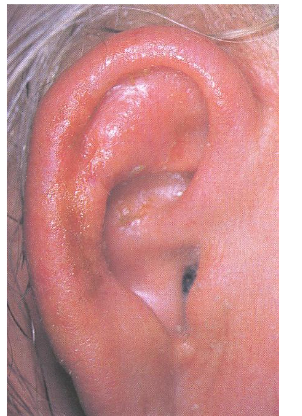 <p>what type of skin lesion is this? </p>
