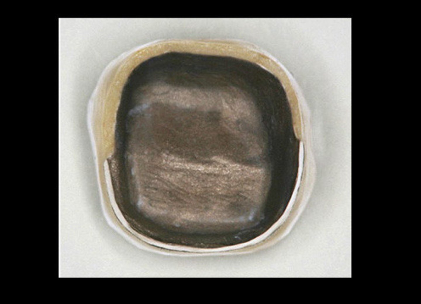 <p>We use porcelain margin when better esthetics are involved (we aren't doing this today)</p>