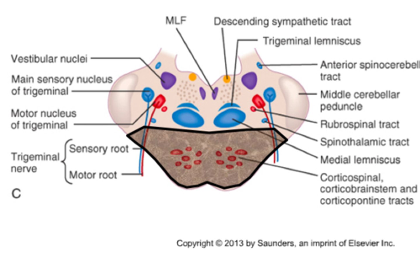 <p>locked in syndrome</p><p>- tetraplegia</p><p>- bilateral cranial nerve palsy (upward gaze is spared)</p><p>- coma</p><p>- cognition is spared</p>