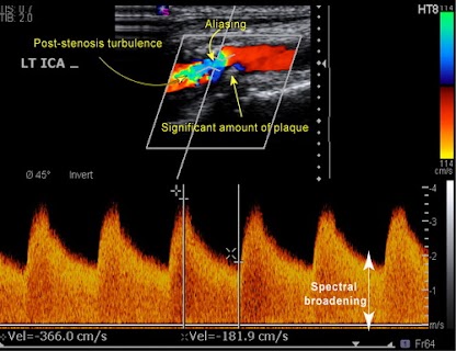 <p>This waveform indicates which of the following criteria?</p>