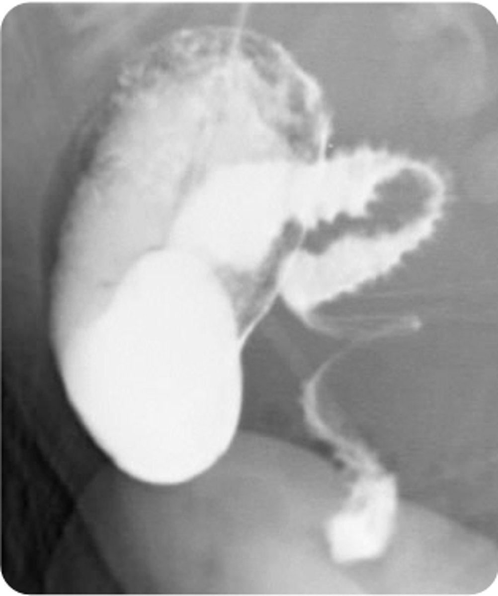 <p>A 1-month-old boy presents with his parents to the emergency department for evaluation of bilious vomit. His parents state that he has been crying and has been inconsolable since this morning. He began to have this type of vomit 2 hours ago. His parents report he has not had a bowel movement today. Vital signs are a blood pressure of 80/45 mm Hg, heart rate of 150 bpm, respiratory rate of 40/min, temperature of 99.2°F, and oxygen saturation of 100% on room air. On physical exam, his abdomen appears swollen and is tender to palpation. An upper GI series is obtained, and the results are shown above. What is the appropriate treatment option for this patient?</p><p>ABarium enema</p><p>BDuodenoduodenostomy</p><p>COpen surgical repair</p><p>DPyloromyotomy</p>