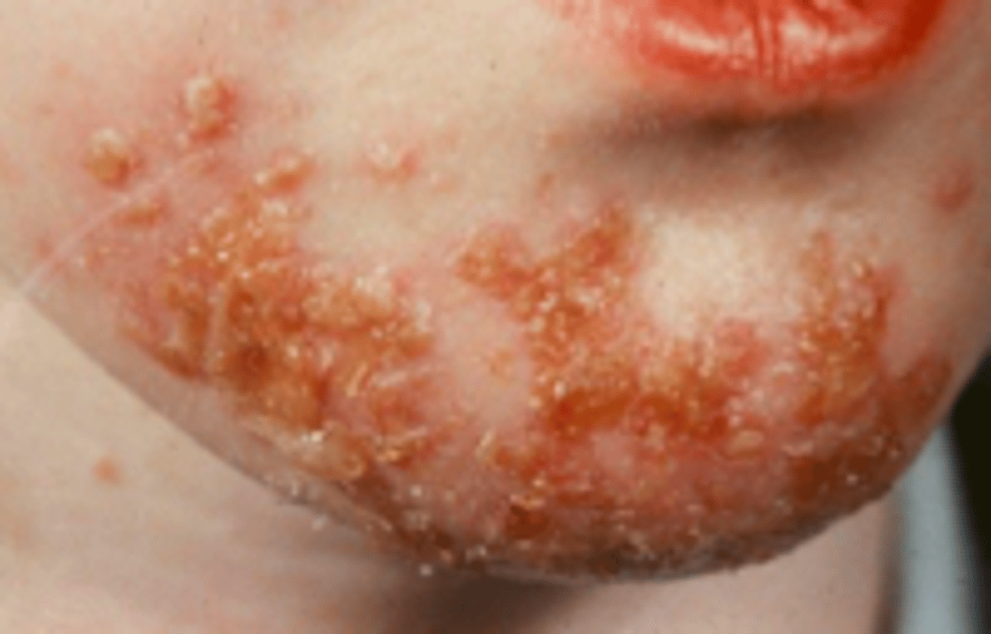 <p>Bacterial Skin Infections:</p><p>erosions with "<strong>honey-colored crusts</strong>" and surrounding erythema</p>