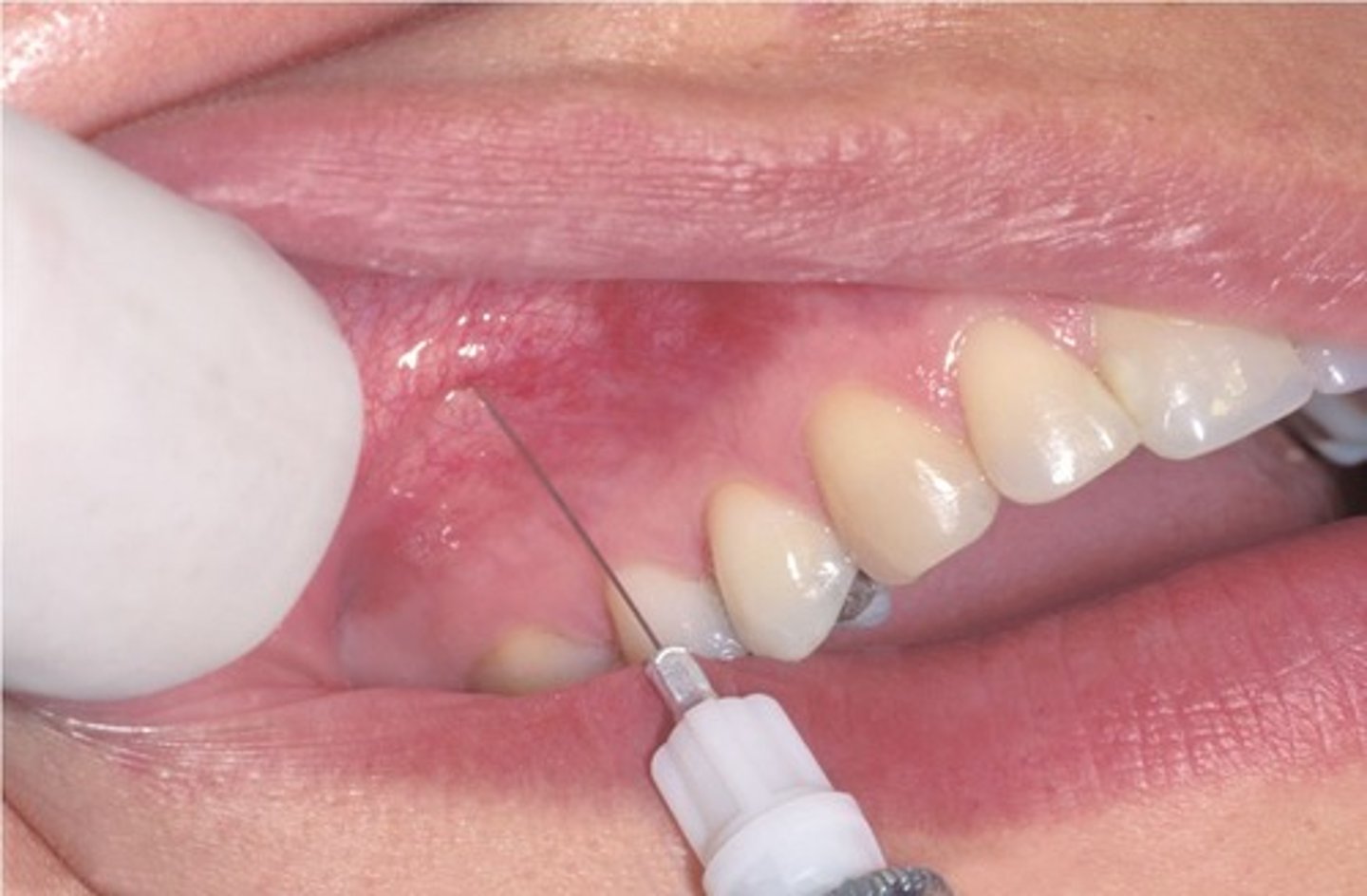 <p>height of mesiobuccal fold at the apex of the maxillary second pre-molar</p>