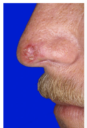 <p>1yr hx of enlarging painless lesion. sometimes bleeds. no hx or other abnormalities</p>