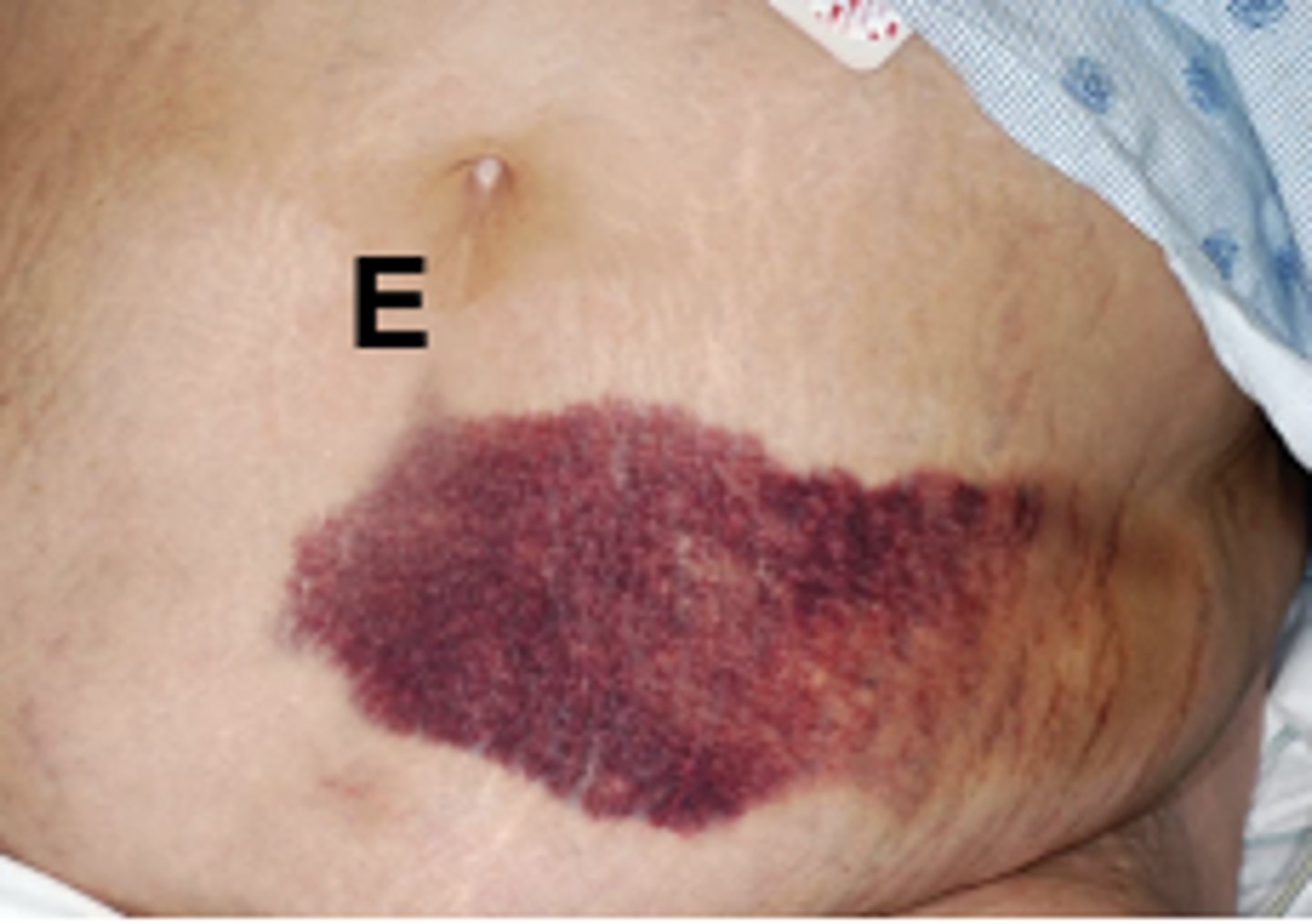 <p>ECCHYMOSIS</p>