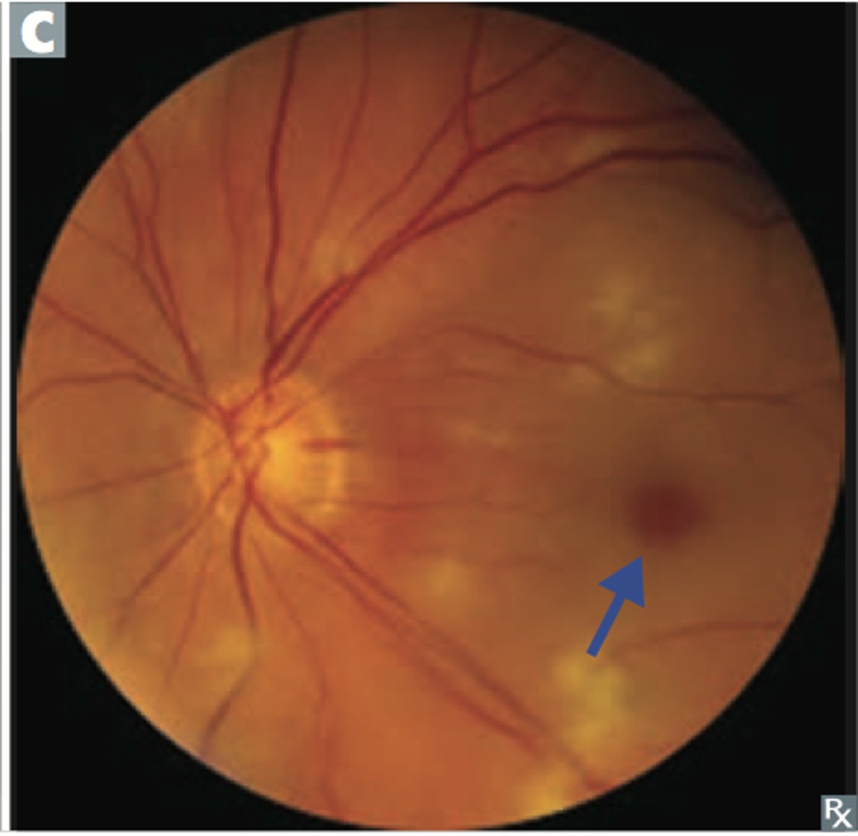 <p><u>Etio</u>: <strong><mark data-color="#ffe800" style="background-color: #ffe800; color: inherit">sudden monocular loss of vision</mark></strong></p><p><u>Risk Factors:</u> &gt;50 y/o, DM, HLD, HTN, OC, AFIB, emboli</p><p><u>S&amp;S</u>: <strong><mark data-color="#fff500" style="background-color: #fff500; color: inherit">cherry-red spot near macula, "Box-car" segmentation</mark></strong></p><p><u>Testing</u>: r/o giant cell arthritis via ESR, DM screen, lipids, cardiac screen</p><p><u>Tx</u>: <strong><u>giant cell</u></strong>= <strong>high dose steroids</strong> and possible temporal artery bx, <strong><u>cardiac</u></strong>= <strong>tx underlying cause</strong></p>