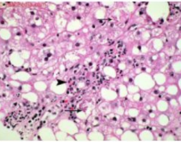 <p>Masculino de 26 años, bebedor frecuente, acude a consulta por malestar general y dolor difuso en hipocondrio derecho. En los laboratorios muestra aumento de las transaminasas hepáticas (ALT, AST), por lo que se decide hacer una biopsia, observándose hepatocitos balonizados, de citoplasma vacuolado, rodeados por infiltrado linfocitario, sin evidencia de fibrosis, como se ve en la microfotografía. El diagnóstico más probable es:</p>