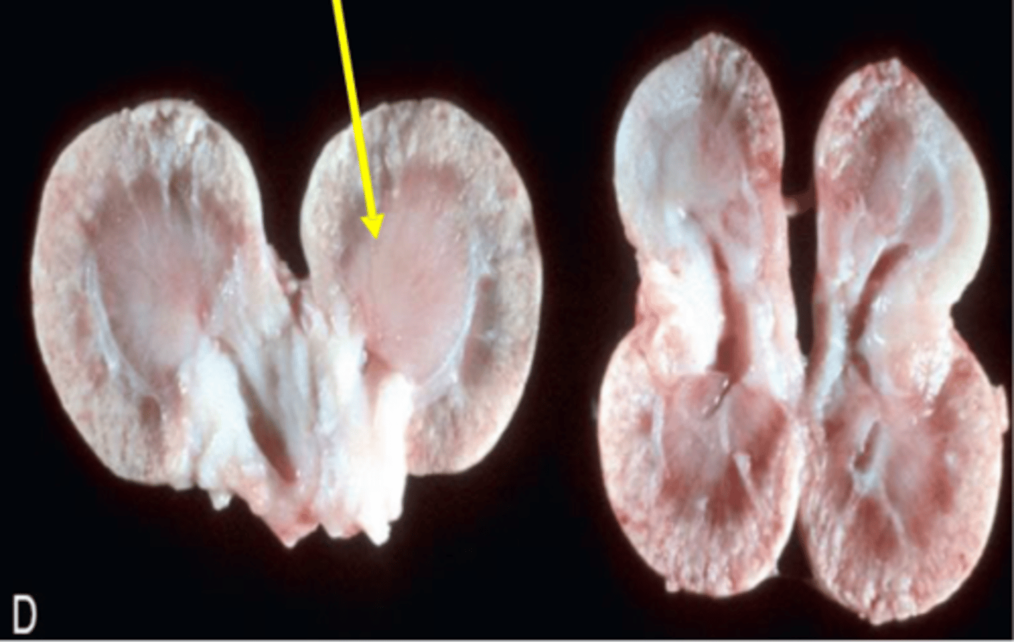 <p>Failure of kidney development leading to disease in early life</p>