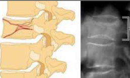 <p>What type of fracture is this?</p>