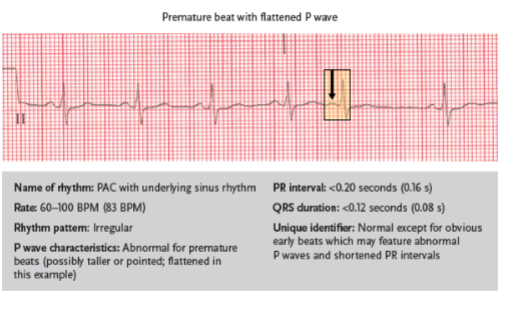 <p>an atrial rhythm featuring obvious premature beats; other aspects of the rhythm are often normal</p>