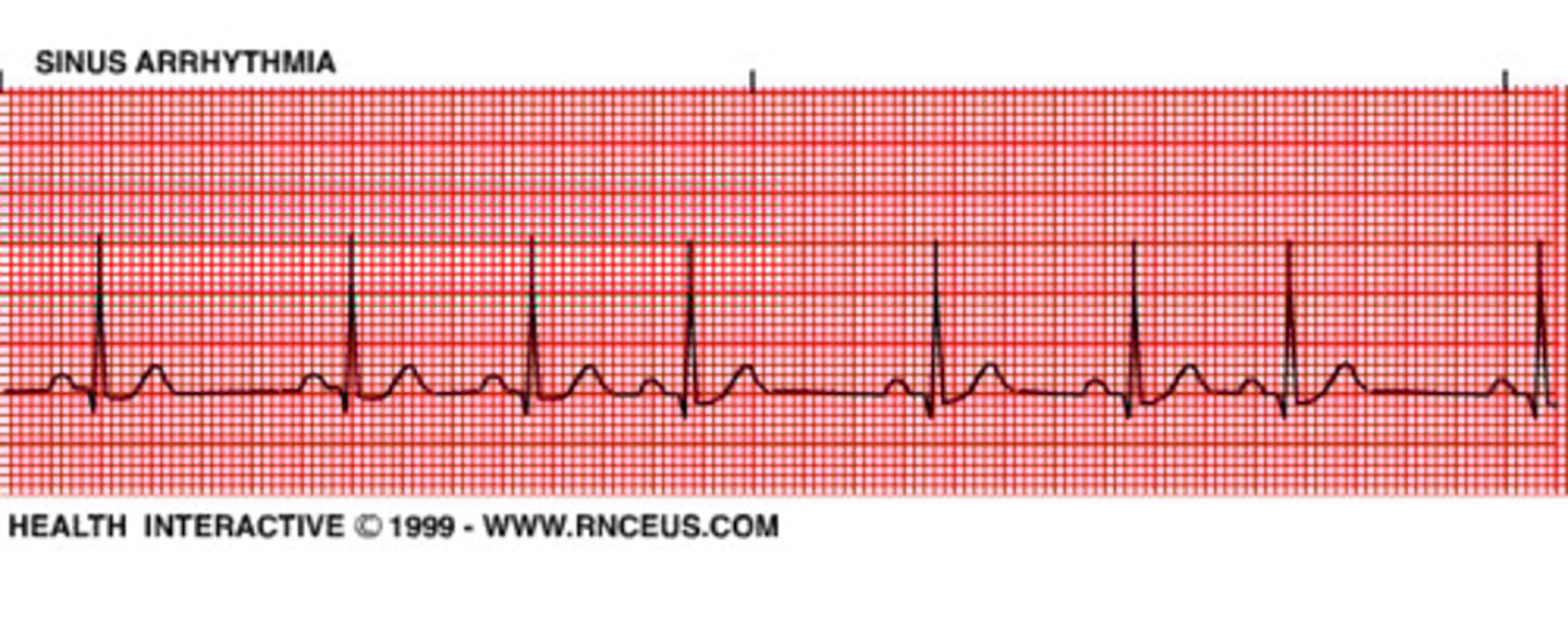 <p>all complexes normal but rhythmically irreg</p><p>- normal finding (esp in young pts) that has to do with breathing (rate: inhale-increase, exhale-decrease)</p>
