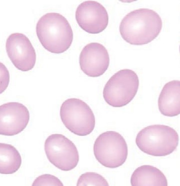 <p><span style="font-family: "Times New Roman", serif">Large, oval-shaped RBCs; common in megaloblastic anemias (e.g., B12 or folate deficiency).</span></p>