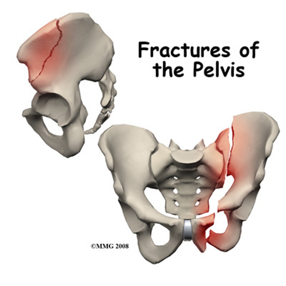 <p>Pelvic fractures can be variable. They can be stable or unstable, simple or complex and they often occur on both sides of the pelvic ring (bilaterally). They are usually caused by high-energy major trauma but may also be caused by deficiency (e.g., osteoporosis) or pathology. </p>