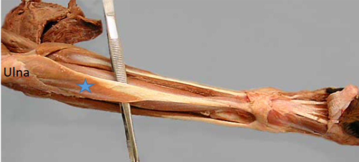 <p>Flexor carpi ulnaris m.</p>
