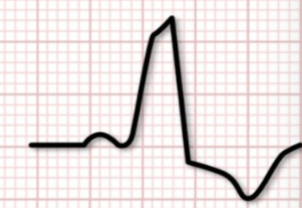 <p>examples of wide QRS complex tachycardias </p>