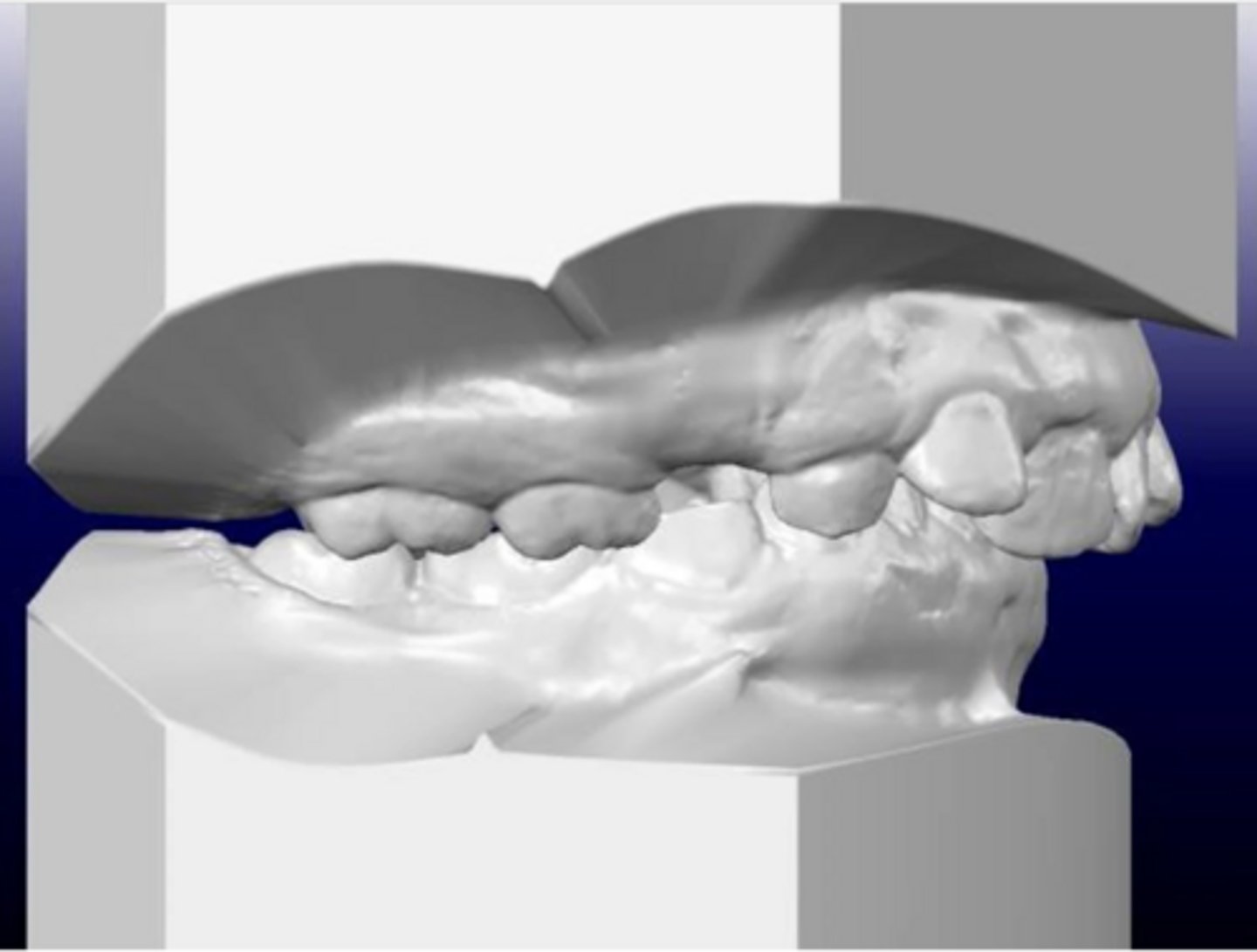 <p>What terminal plane does this patient have, and what kind of malocclusion will it become?</p>