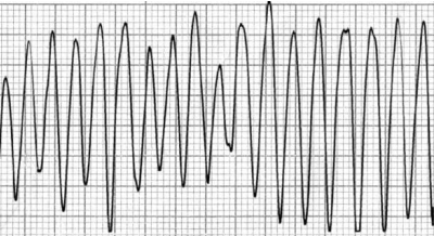 <p>What does the EKG show?</p>