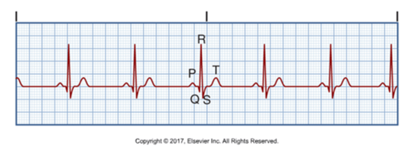 <p>Rate: 60-100</p><p>P waves: upright, matching previous ones</p><p>PR: 0.12-0.20 secs</p><p>QRS: &lt; 0.12 secs</p>