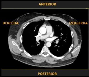 <p>Por el corte ___ pordemos identificar a la TC.</p>