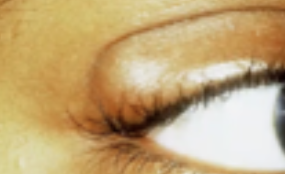 <p>Abnormalities of the External Eye</p><ul><li><p>Infected meibomian gland</p></li></ul><p></p>