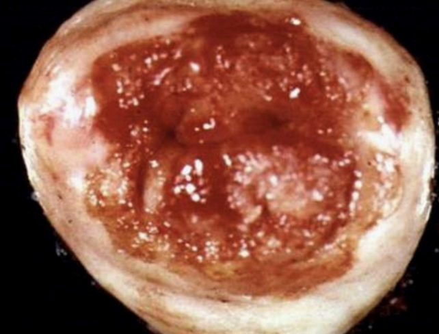 <p>Squamous Cell Carcinoma</p>