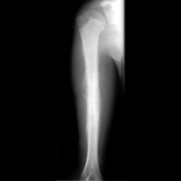 <p>Ewing sarcoma</p>